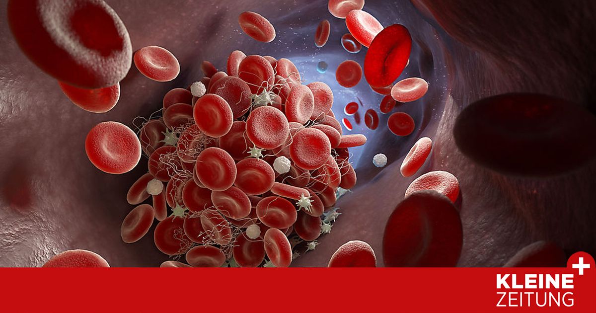 Inquiry: Blood clots: questions and answers about thrombosis